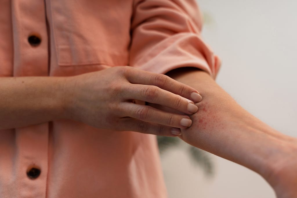 dermatite da stress